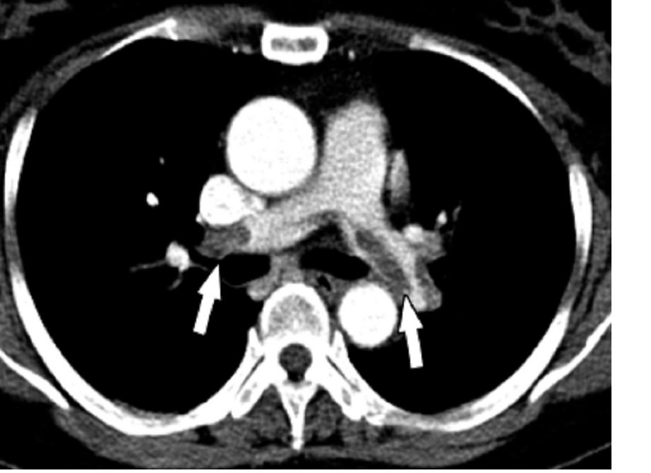 An X-ray of an pulmonary embolism